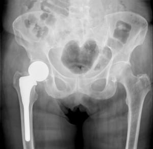 metal hip replacement lawsuit
